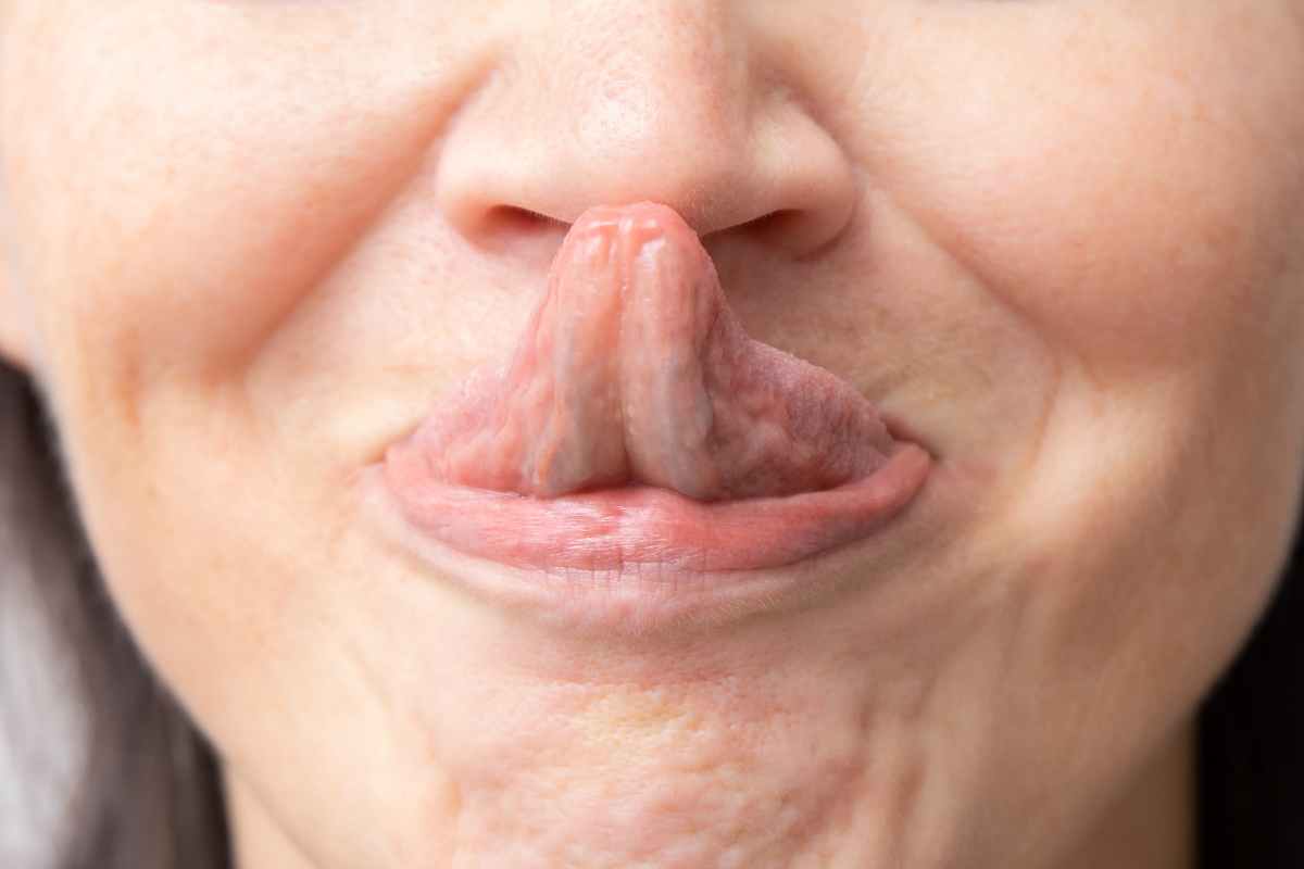 what is Ehlers-Danlos syndrome